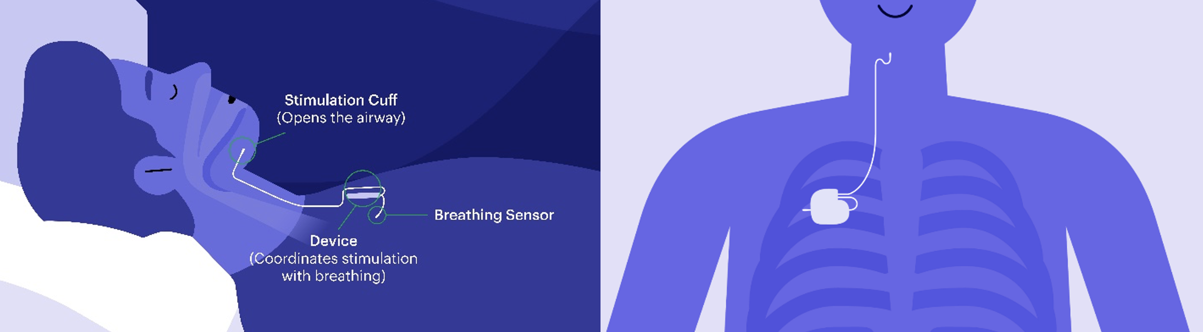 illustrations-of-how-the-implant-is-in-the-body illustrations-of-how-the-implant-is-in-the-body